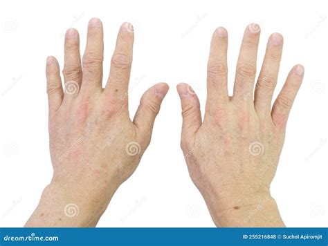 Fingers Dark Brown Spots at Beth Heard blog