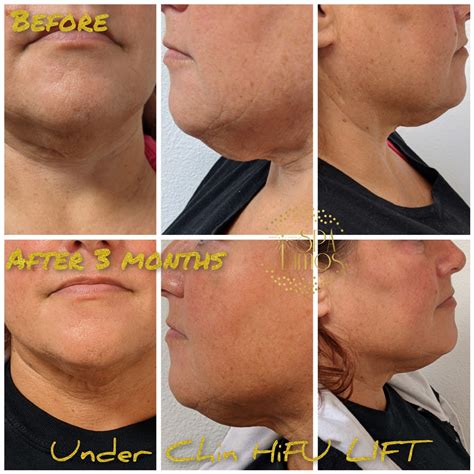 HiFU LIFT in Boise, ID | Spa Lumos — Spa Lumos