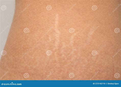 Stretch Marks on the Body Skin of Female Thighs Stock Photo - Image of ...