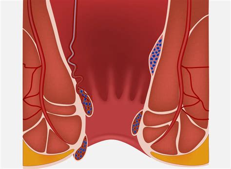 Hemorrhoid Artery Embolization