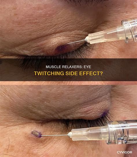 Muscle Relaxers: Eye Twitching Side Effect? | CyVigor