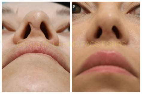 Bad Rhinoplasty Before And After 10 Nose Jobs Gone Wrong Ideas