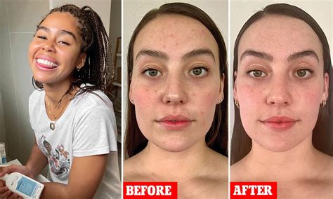 Meet Azelaic Acid: The Unsung Hero For Fighting Acne And, 57% OFF