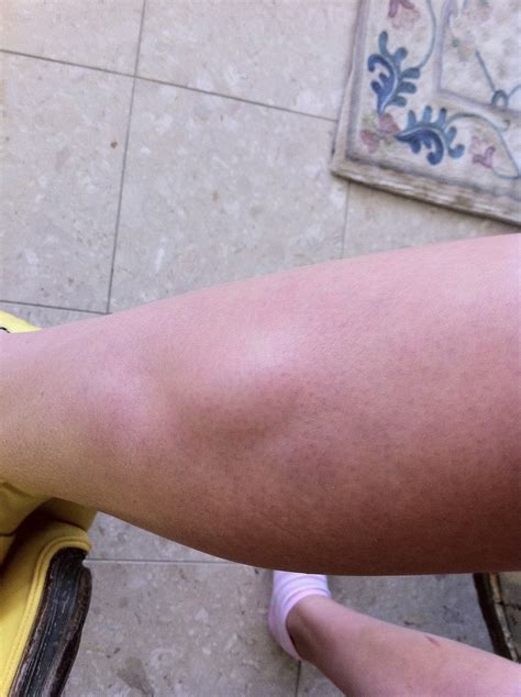 Lower Leg Shin Lump at Norma Friedland blog