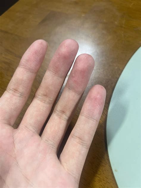 Pimples/blisters on fingertips : r/medical_advice