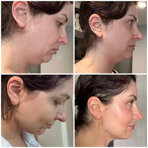 revision rhinoplasty : r/PlasticSurgery