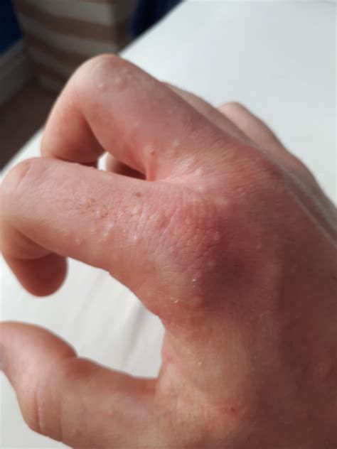 Water Bumps On Hands