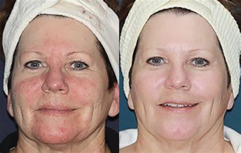 Laser Treatment For Rosacea Swelling at Kenton Bridges blog