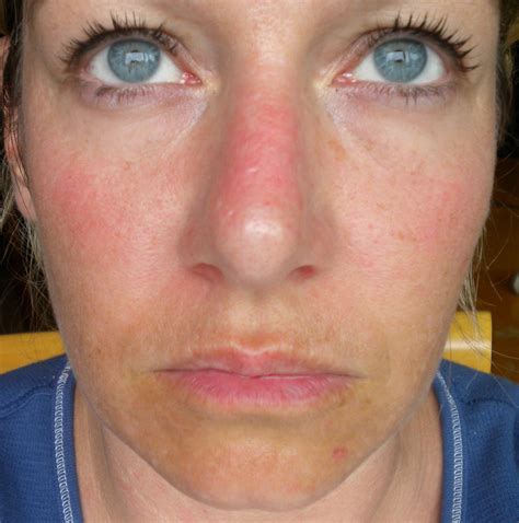 Keratosis Pilaris Forehead