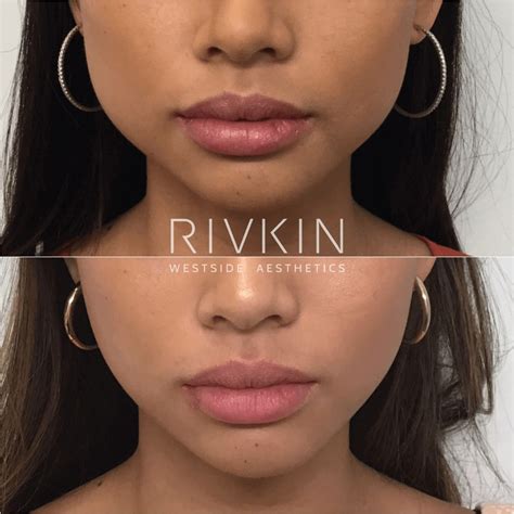 Non Surgical Jaw Reduction - RIVKIN Aesthetics