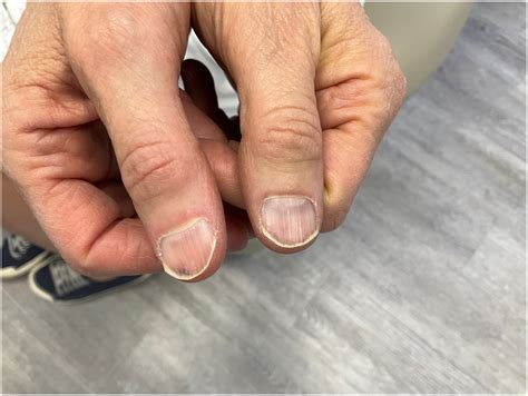 Nitrofurantoin-induced splinter hemorrhages: A forgotten culprit - JAAD Case Reports