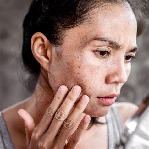 Liver Spots Treatment St. Paul, MN / Roseville, MN