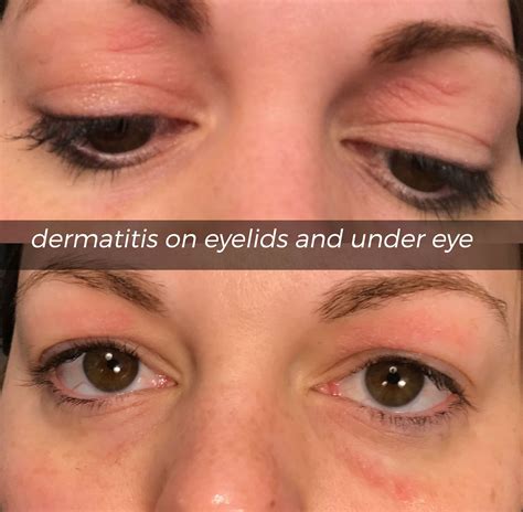 Eczema On Eyelids Relief at Marcus Hanger blog