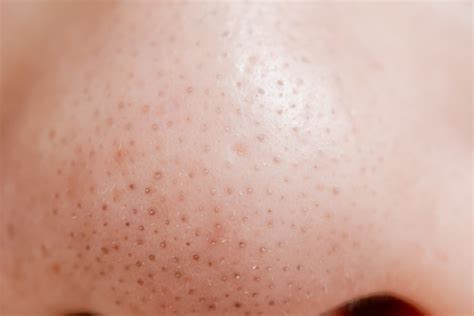 Sebaceous Filaments vs Blackheads: What’s the Difference?