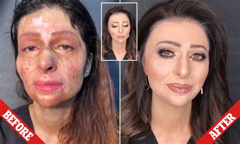 Burned Face Before And After