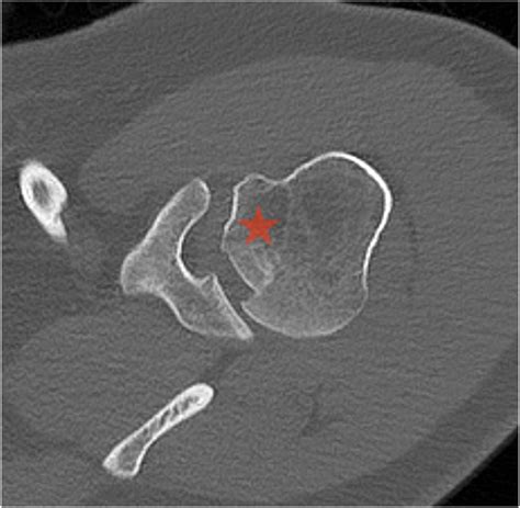 Arthroscopic Subdeltoid Humeroplasty in the Beach-Chair Position for Reverse Hill-Sachs Lesions ...