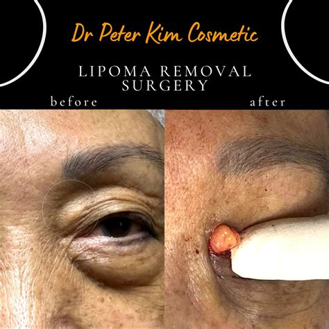Lipoma Surgery, Treatment, Removal Sydney – TYEX