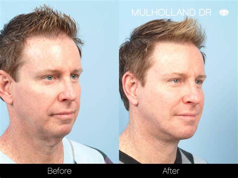 Double Chin Surgery For Men | Toronto Plastic Surgeons
