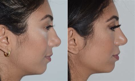 Rhinoplasty Can Fix a Crooked Nose | Miami, FL