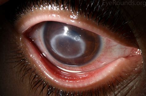 Acanthamoeba Corneal Ulcer