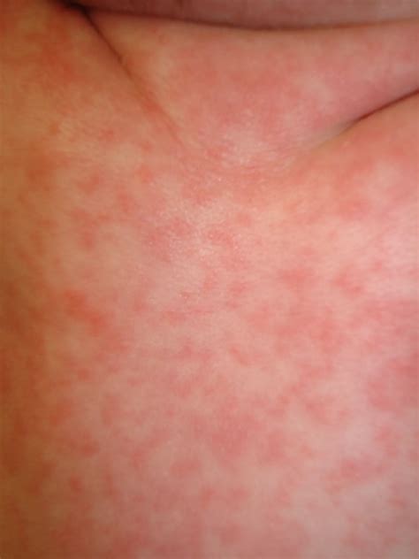 Measles Rash Pictures and Other Signs to Watch For