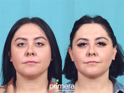 Buccal Fat Removal photos, Orlando, FL