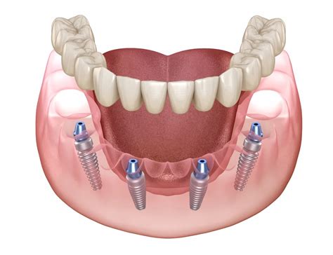 What Do Dental Implants Look Like? Complete Visual Guide & Comparison ...