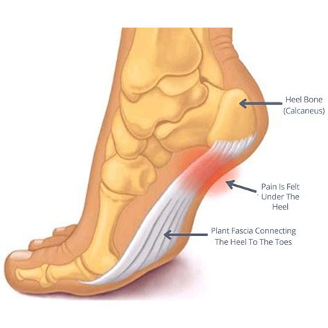 Heel Pain With Running – Best Treatment & Exercise For Plantar ...