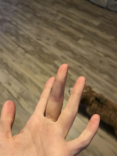 Why Do I Break Blood Vessels In My Hands at Jason Quinn blog