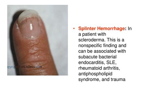 PPT - Antiphospholipid syndrome PowerPoint Presentation, free download - ID:9103764