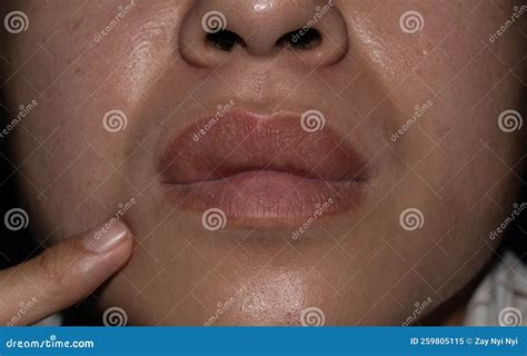Allergy Lip Swelling One Side at Magda Salas blog