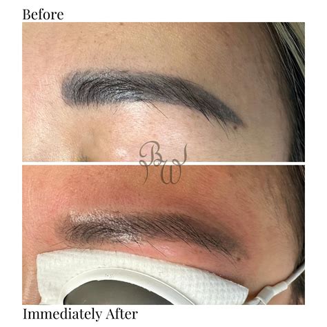 What is the best way to remove permanent eyebrow microblading? - Bush Whacked Laser