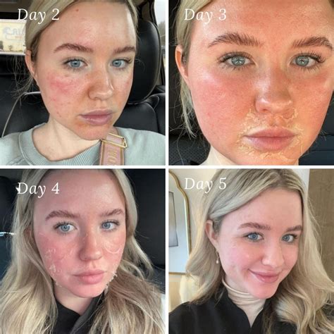 How Often Can You Get A Chemical Peel - EMSEKFLOL.COM