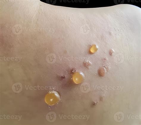 A closeup of skin with multiple fluid filled blisters characteristic of bullous pemphigoid ...