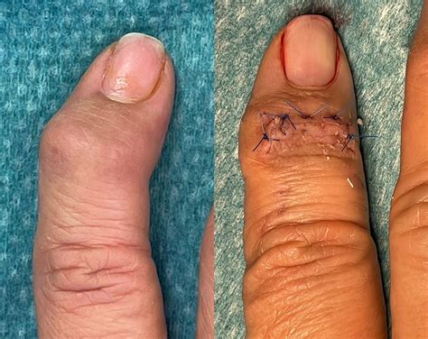 Joint Fusion & Joint Replacement | Advance Hand, Wrist & Nerve Centre