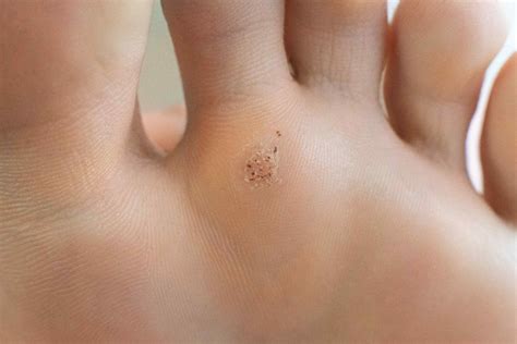 Are Warts Contagious? Protecting Yourself and Others - Well Heeled Podiatry