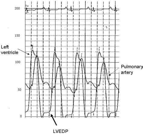 Heritable Pulmonary Arterial Hypertension With Elevated Pulmonary Wedge ...