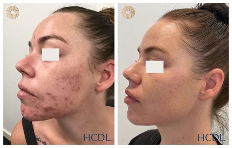 CO2 Laser Resurfacing Cost: Worth It for Flawless Skin?