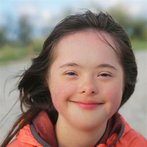 Down Syndrome Physical Features and Facial Characteristics