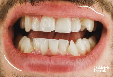 How to Fix a Chipped Tooth | Oakleigh Dental