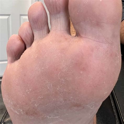 Athletes Foot Moderate Severe Case Athletes Foot Tinea Stockfoto