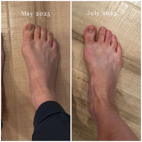 How to Treat Bunions Without Surgery: A Physical Therapist’s Guide | MovementX