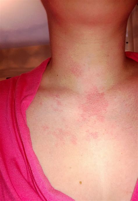 Skin Rashes Caused By Stress And Anxiety at Robert Bader blog