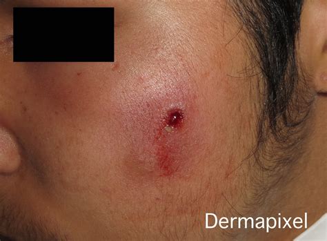 Dermapixel: Abscesos recurrentes por SAMR en niños: Se pueden prevenir