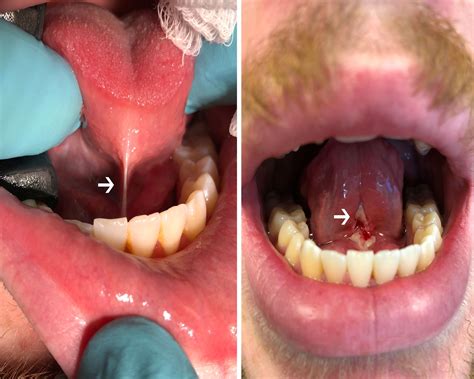 Attached Frenulum Tongue