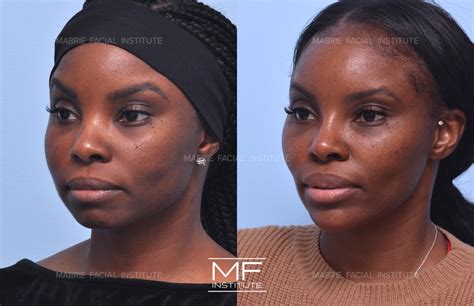 Face Slimming Surgery