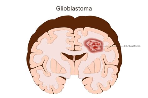 Glioblastoma - Creative Diagnostics