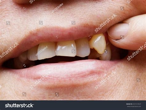 Canine Teeth Human