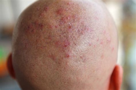 Eczema Scalp