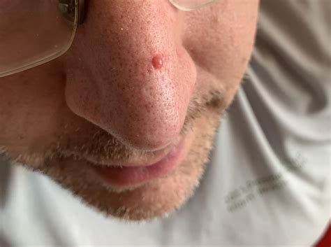 Skin cancer? Shiny pink bump on nose. 41 yo male : r/skincancer
